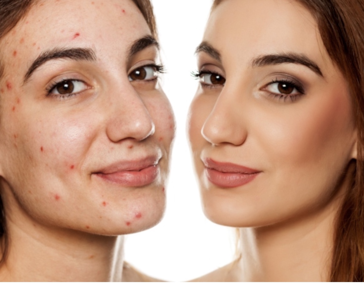 Top 10 Evidence Based Products for Mild Acne 